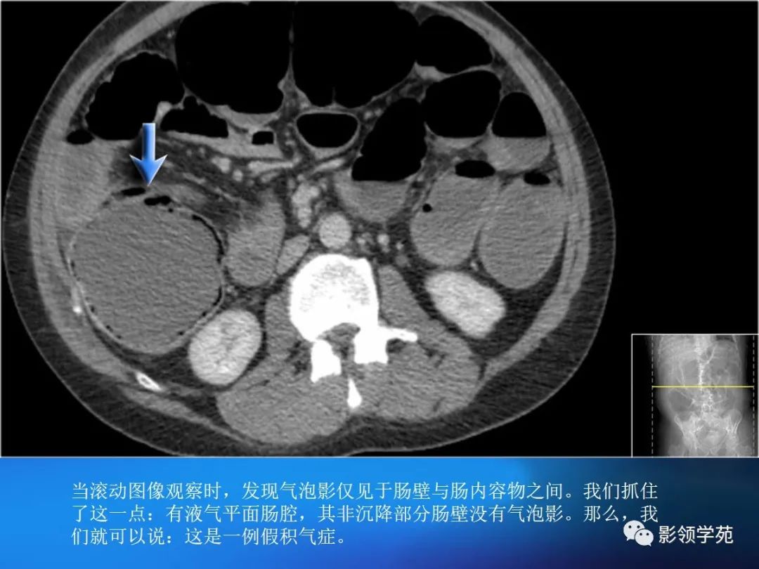 肠道内壁增厚,肠道扩张ct表现