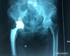 老年人骨折最怕什么病,老年人最常见的骨折有哪些