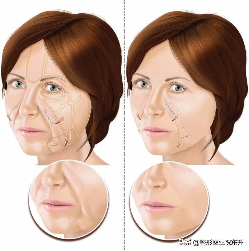 去法令纹最有效的办法亲测,去除法令纹最佳方法费用