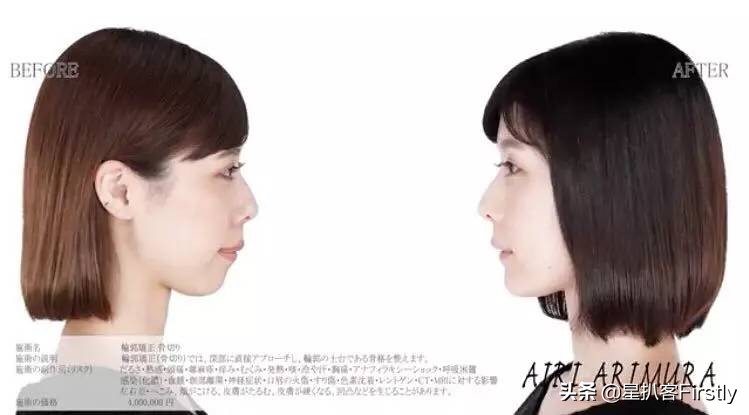 下颌骨缩小整容,下颌骨切除整容