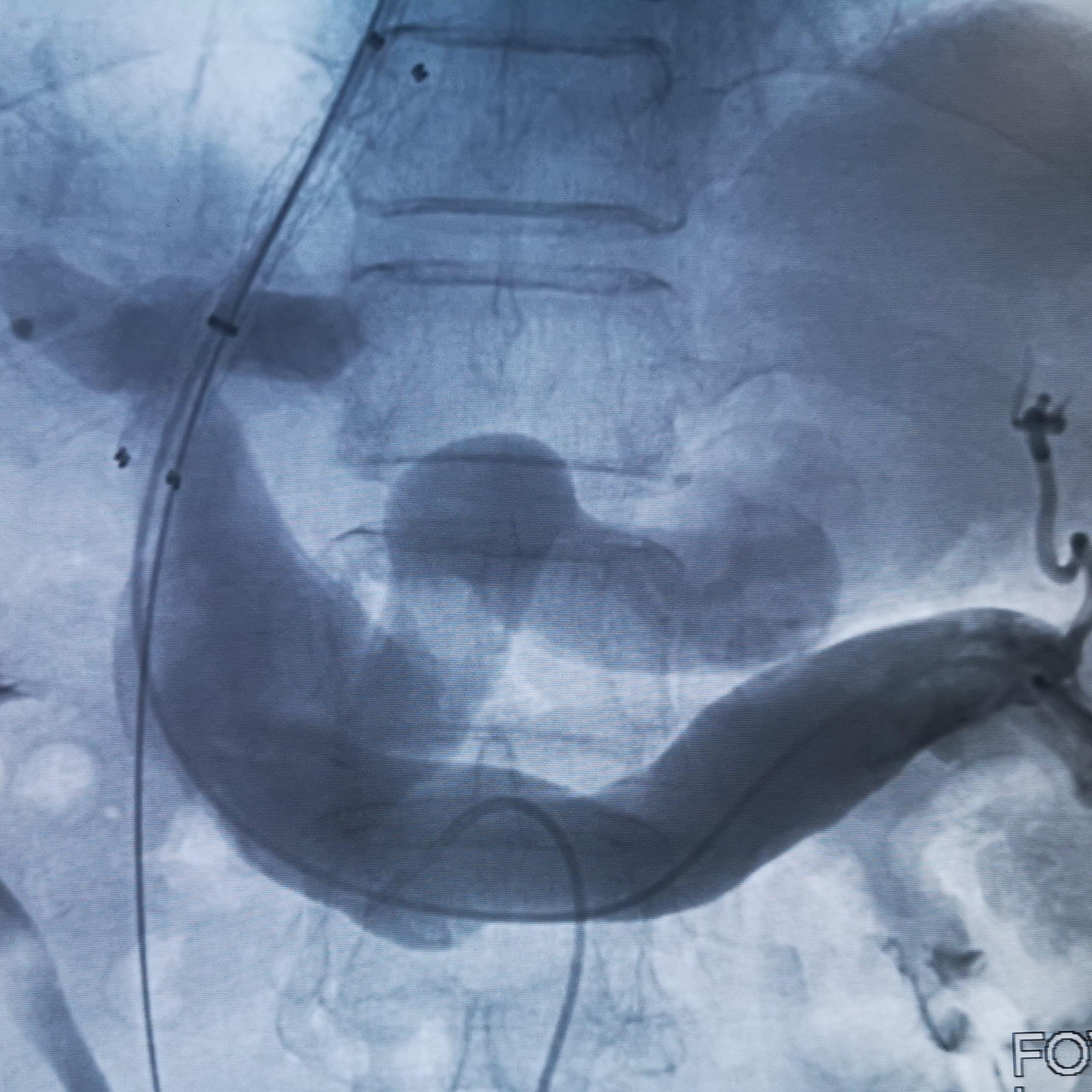 肝硬化消化道出血的病例护理讨论,肝硬化引起的消化道出血如何治疗