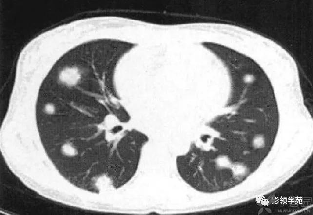 肺肉芽肿影像学表现ppt,肺韦格纳肉芽肿影像学表现