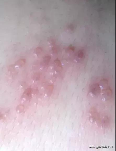 手臂腿上小水泡抓破很痒,手上脚上起小水泡很痒是怎么回事
