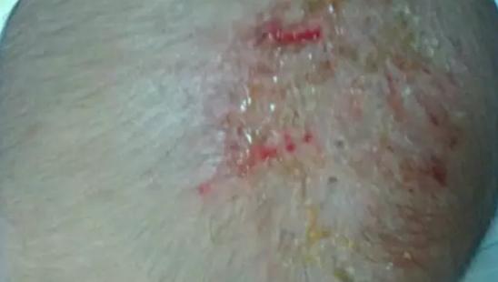 素东方科普|宝宝头上有头垢如何护理？