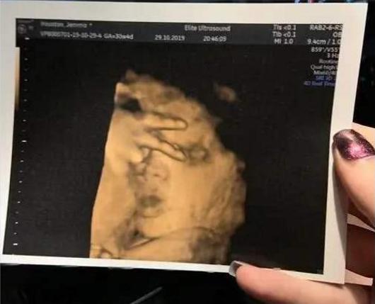 孕妇做b超胎儿在开车视频,b超胎儿开车