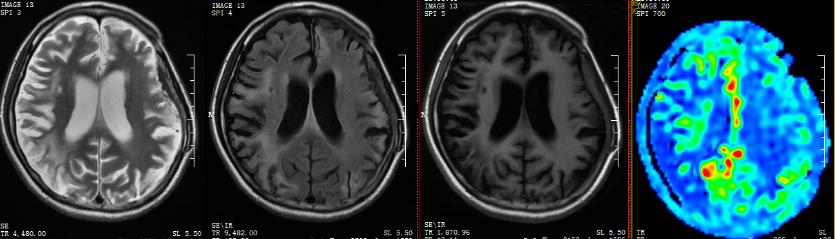 医生给脑血管搭桥,外科医生给年轻女孩做手术