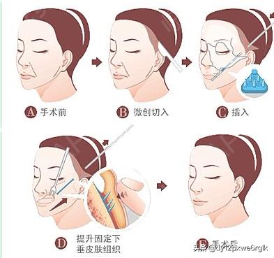 拉皮除皱术后恢复要多久,拉皮除皱后恢复需要多长时间