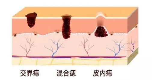 中医点痣治疗法,神奇中医点痣
