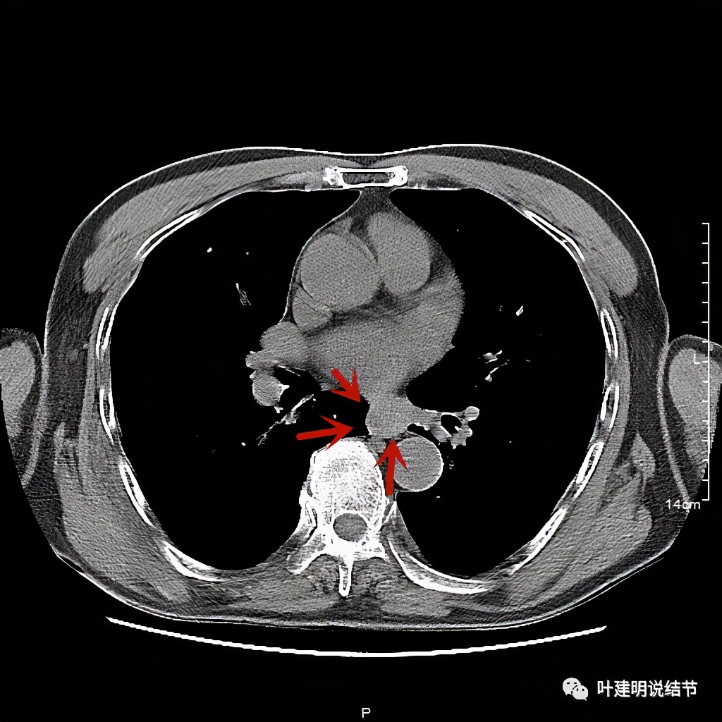 同时患结肠癌和直肠癌怎么办,同时查出了胃癌和肺癌怎么办