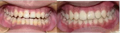 牙齿为什么有白斑点,牙齿脱矿白斑用涂氟剂可以修复吗