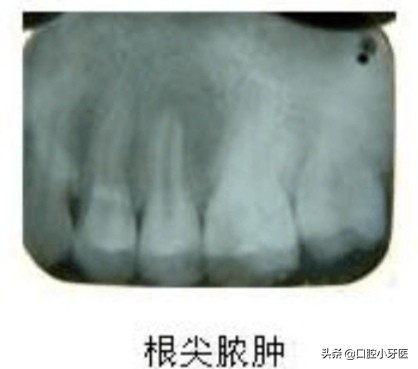 牙齿疼痛难忍吃药后不再疼痛是真的好了吗？事实不是你想的那样！