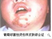 葡萄球菌性烫伤样皮肤综合征表现,葡萄球菌性烫伤样皮肤综合征原因
