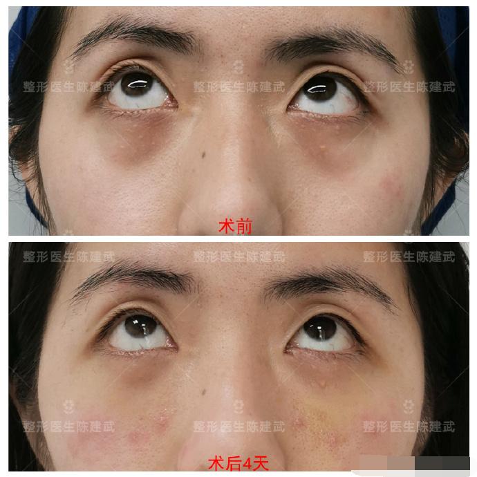 29分钟快速祛眼袋,女士微创去眼袋