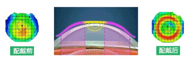 上海和平眼科医院医生,100度以下角膜塑形镜可以恢复视力