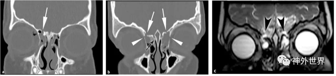 颅底骨折合并脑脊液漏伤情鉴定,颅底骨折伴脑脊液漏右眼眶骨折