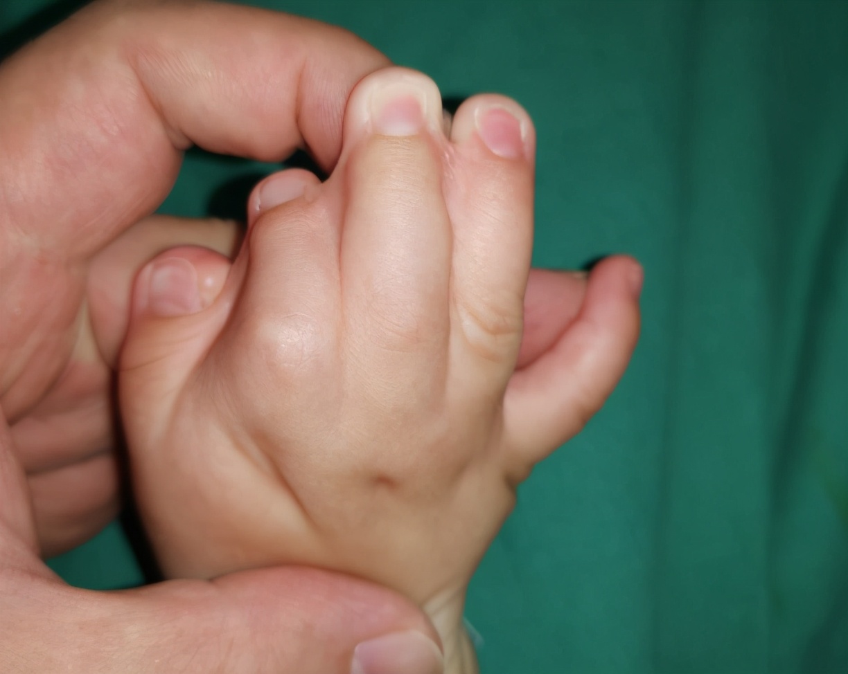 先天性并指畸形科普以及案例分享,先天性并指畸形