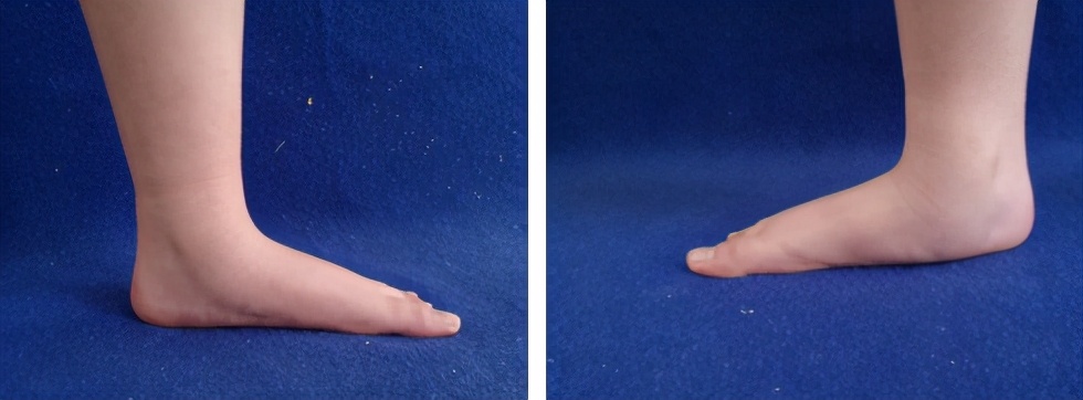 8岁小孩跑步总是跌倒怎么办,扁平足的孩子跑起来老是摔跤