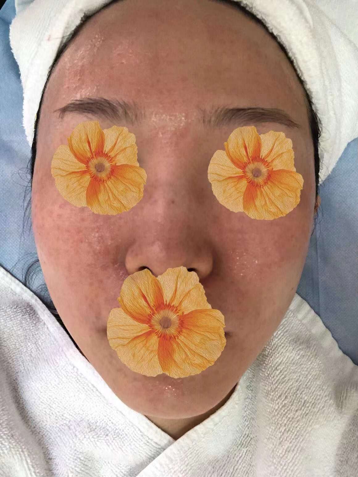 我的医美笔记-水光针