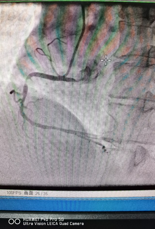 信阳市中心医院心脏射频消融手术,信阳中心医院心血管科室怎样