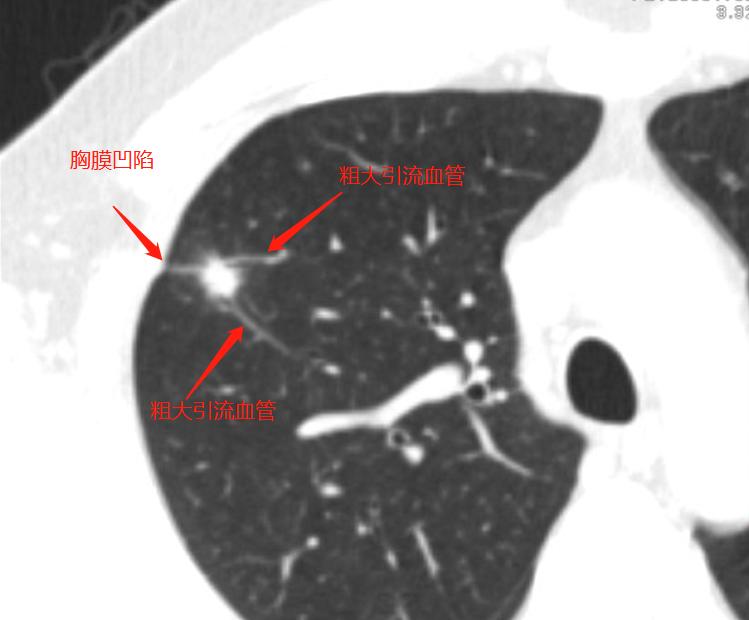 9mm肺结节实性结节良性几率多大,良性肺结节生长速度