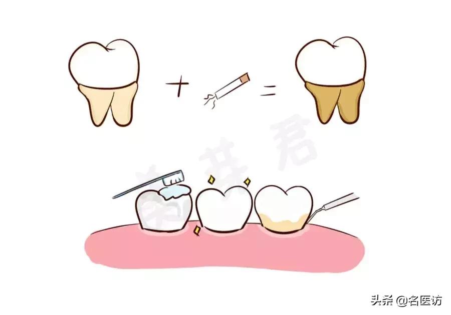 洗牙攻略,洗牙全攻略