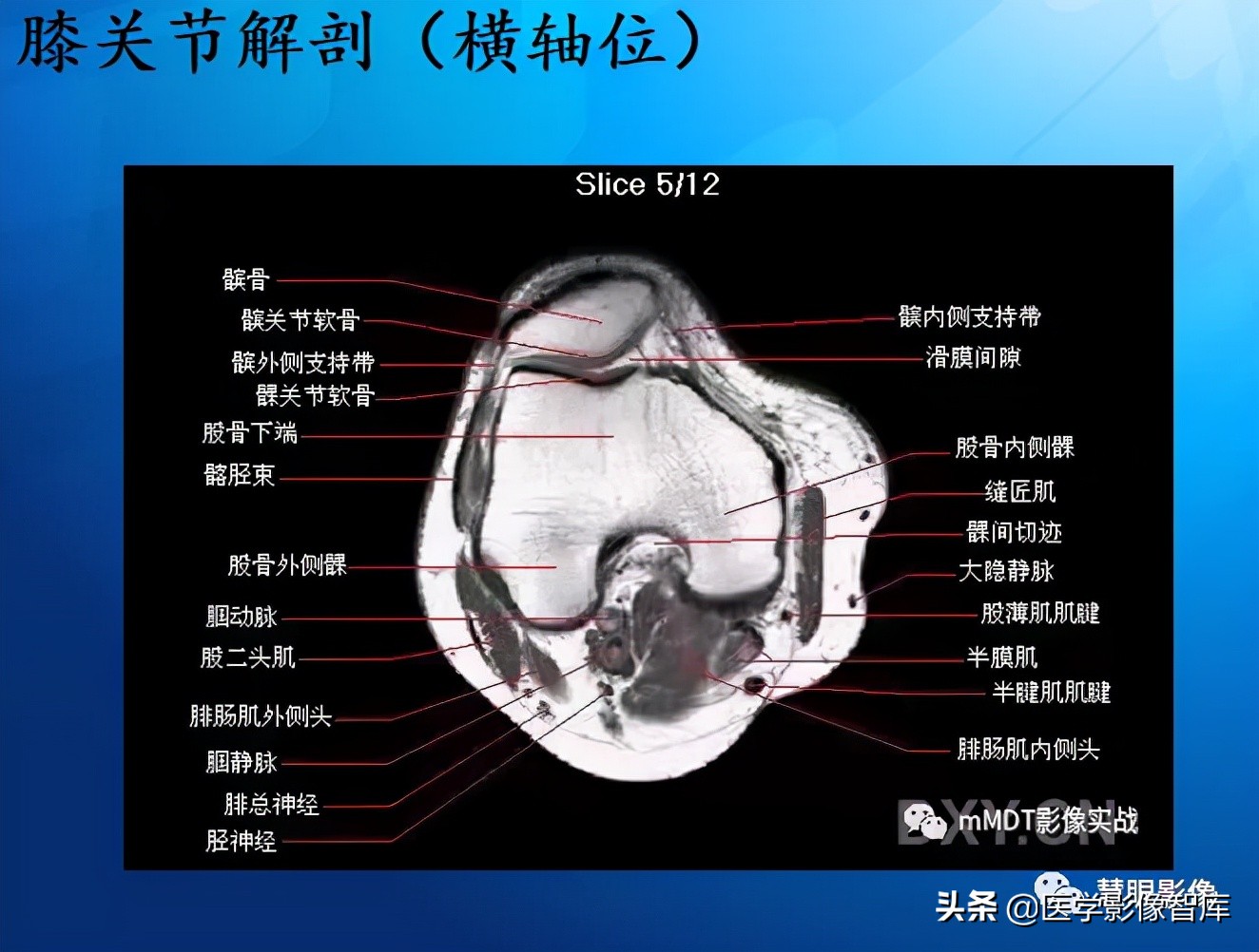 膝关节半月板损伤的解剖结构图,半月板mri解剖图解