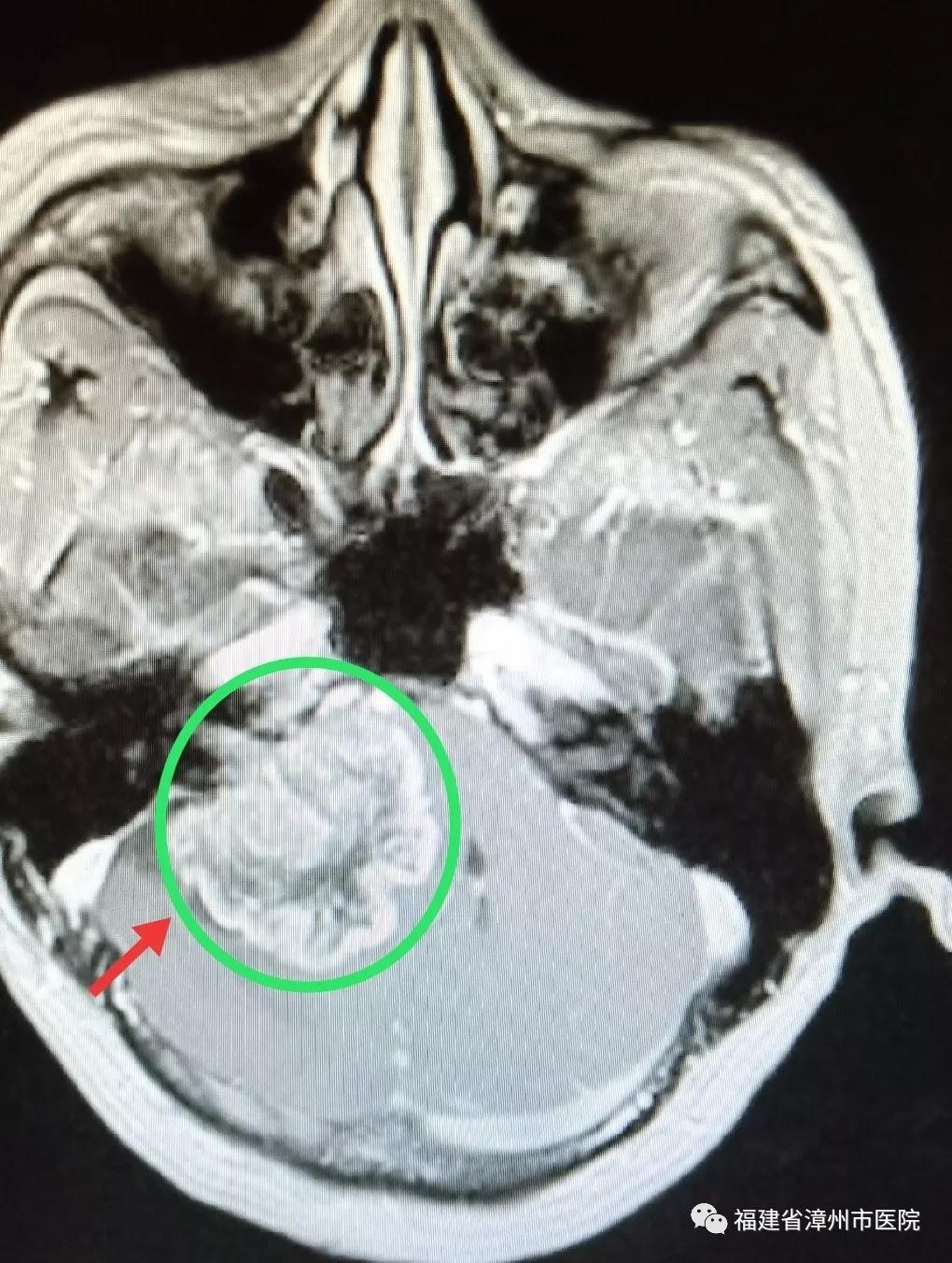 听力下降是耳朵出问题吗,着急一侧耳朵耳鸣听力减退