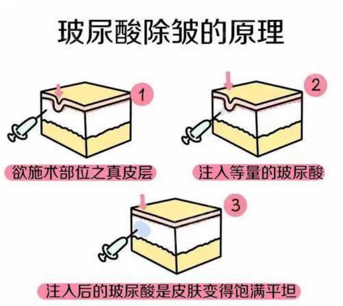 注射玻尿酸和肉毒素除皱皮肤紫红,肉毒素除皱后可以做玻尿酸填充吗
