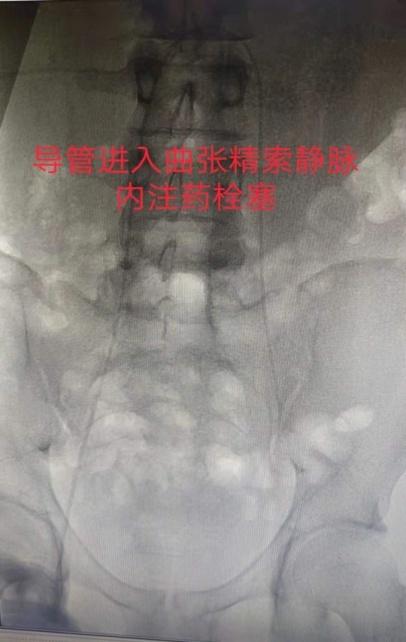 小伙子兵检不合格,当兵血管瘤不合格可以复检吗