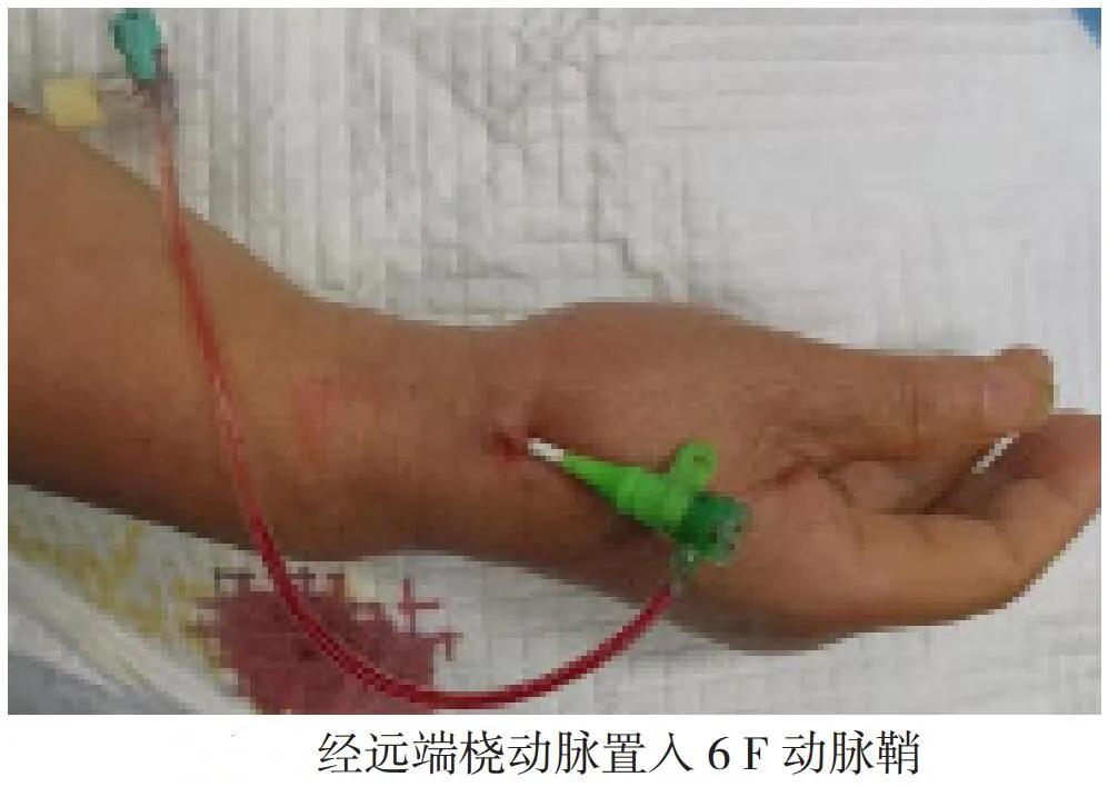 桡动脉介入治疗护理要点,经桡动脉行冠状动脉造影术的护理