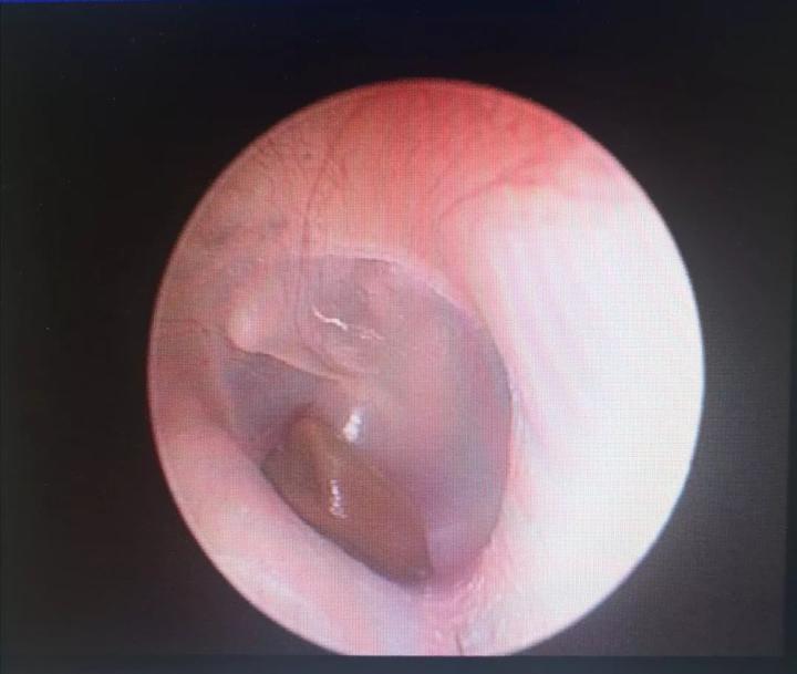 孩子耳朵里进了一颗决明子有事吗,耳朵进了一颗决明子怎么办