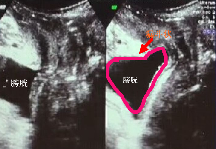 孕中期漏尿是盆底肌受损吗,产前漏尿需要做盆底肌修复吗
