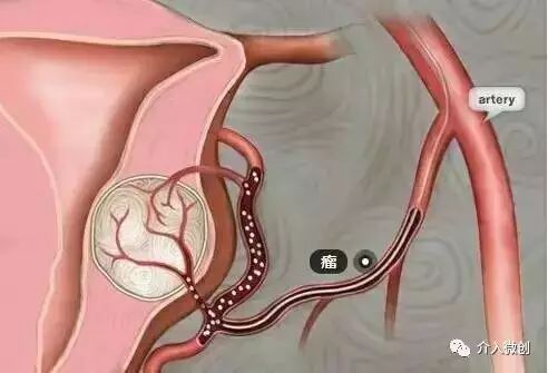 从手上扎针插管就能治子宫腺肌症——经桡动脉入路子宫动脉栓塞术