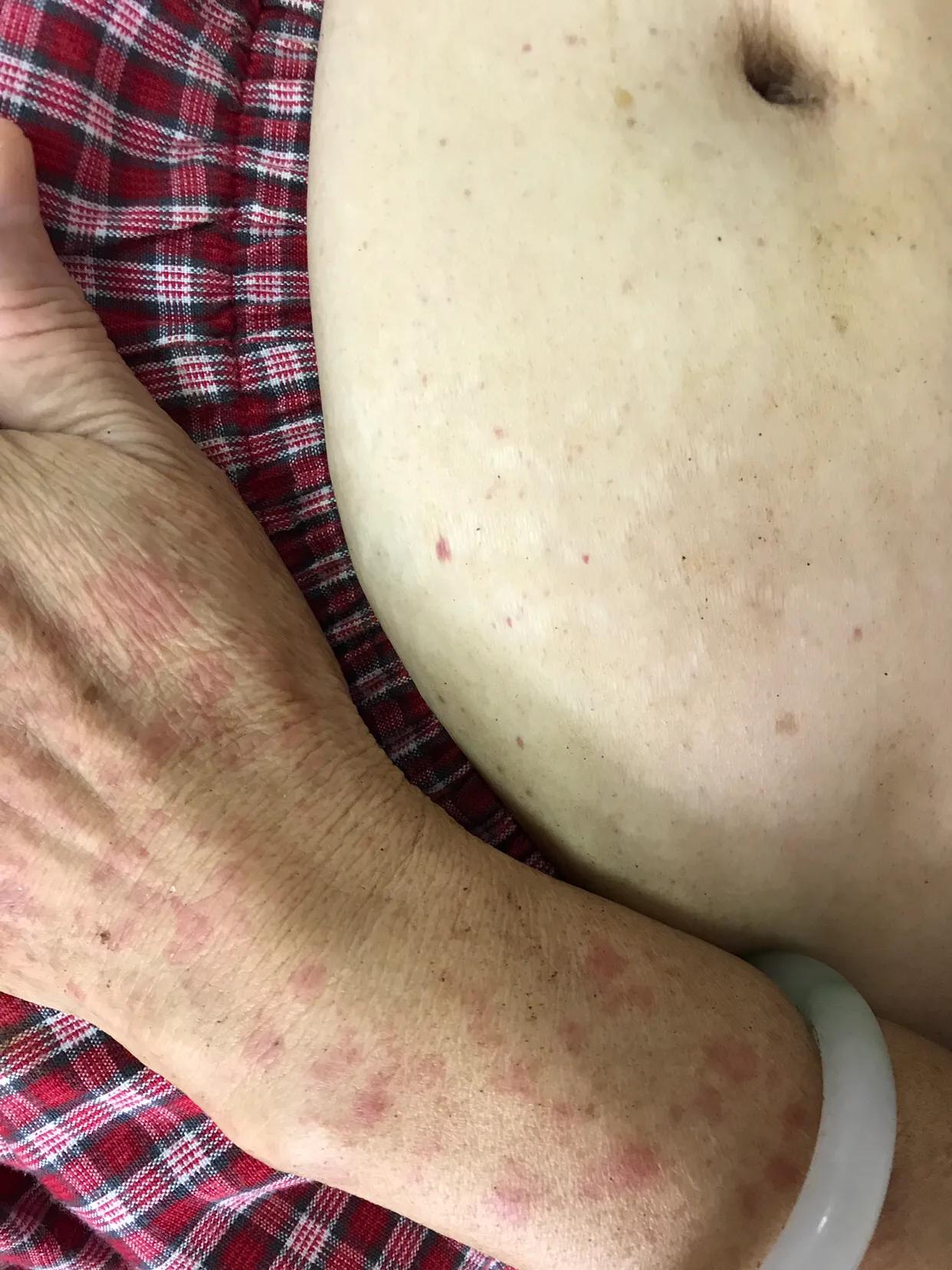 过敏性紫癜的鉴别图片,过敏性紫癜反复出零星小点