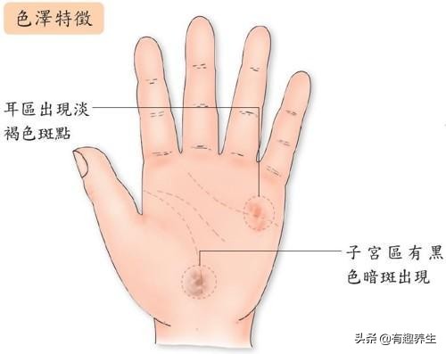 如果子宫长了瘤会有什么特征,手掌子宫输卵管卵巢反射区