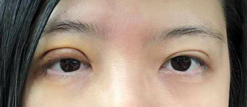 双眼皮手术后问题,双眼皮术后怎么才知道恢复好了没