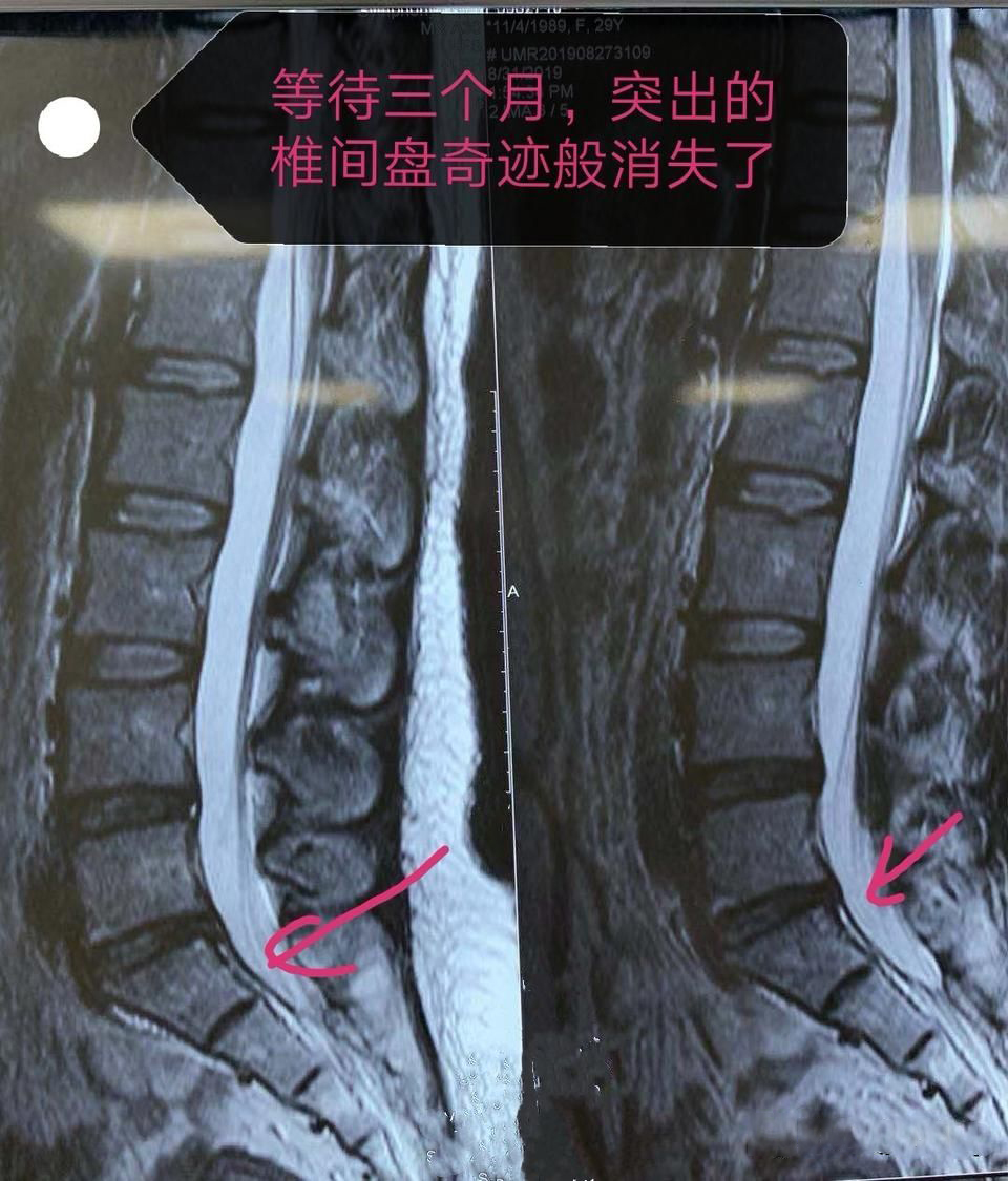椎间盘突出病案分析,腰椎间盘突出做手术好久恢复正常