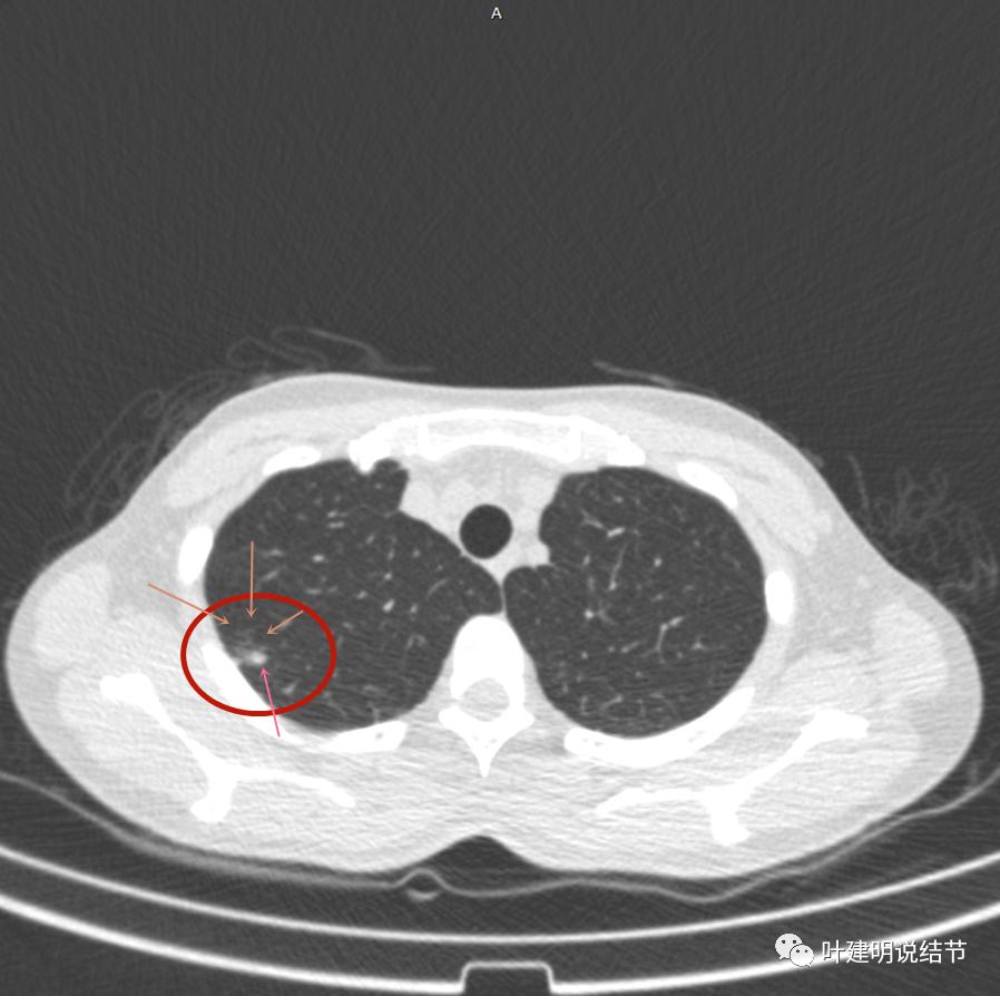 临床诊断孤立性肺结节,空洞型结节一般是什么性质