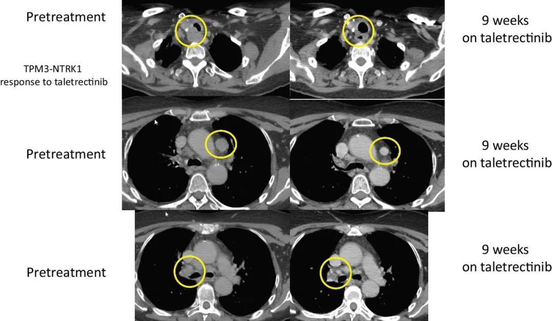 ros-1耐药患者,ros1耐药后治疗方案