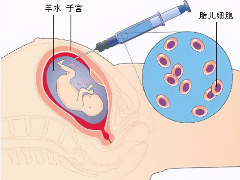 羊水穿刺可以排查出哪些畸形,羊水穿刺可以排除多少疾病