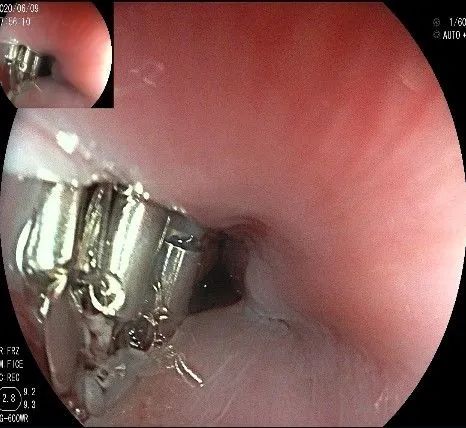 贲门处见隆起性病变,贲门高级别瘤变esd术后不能吃什么