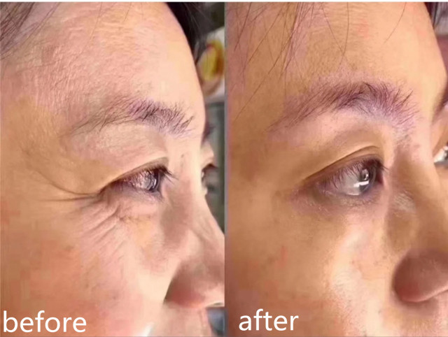 想要皮肤皱纹少这三个动作少不了,30岁出现了皱纹松弛可逆吗