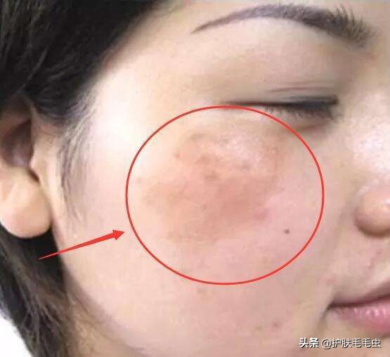脸上长斑什么原因怎么消除,脸上长斑严重如何调理最简单有效