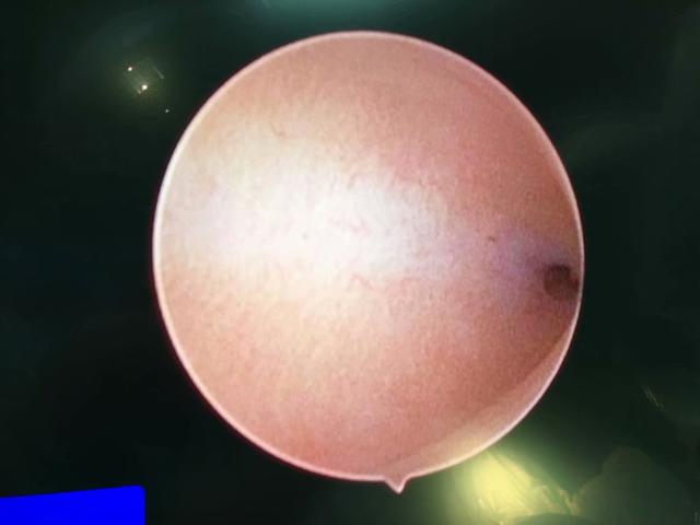 宫腔镜腹腔镜动画,宫腔镜和腹腔镜检查全过程