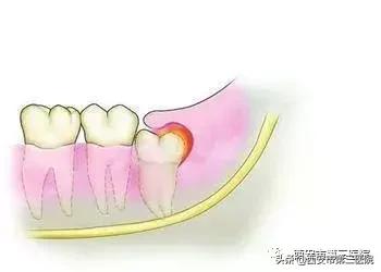拔智齿不拔牙根会怎么样,拔下面智齿上面不拔可以吗