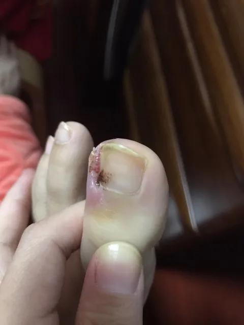 儿童怎么预防甲沟炎,美甲能预防甲沟炎吗