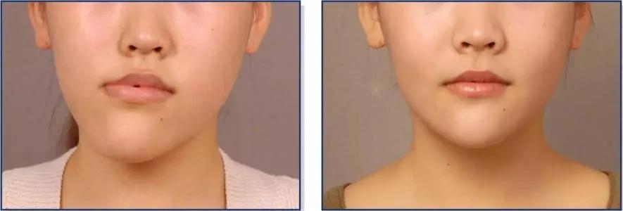 咀嚼导致的大小脸怎么恢复,单侧咀嚼大小脸可以恢复吗