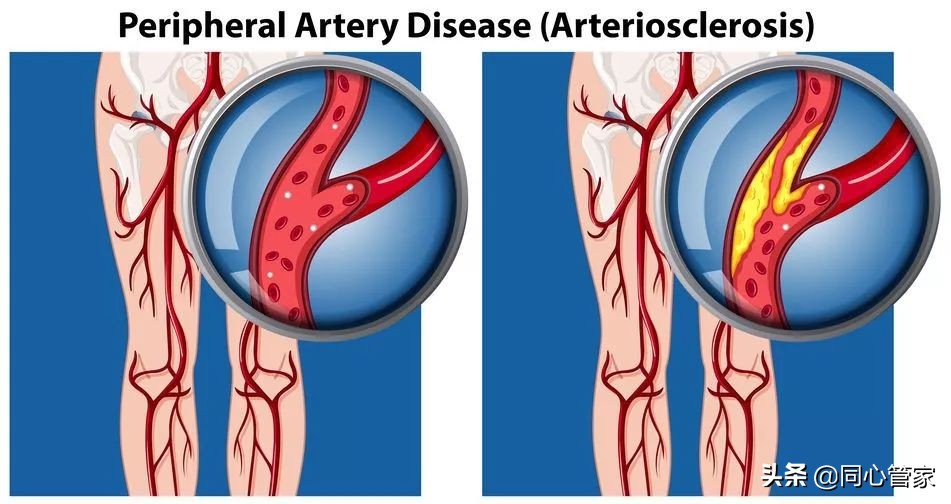 血管狭窄如何扼住生命的咽喉?让你全身器官都遭殃