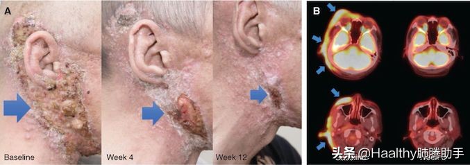 肺癌罕见基因突变,肺癌罕见基因治疗进展