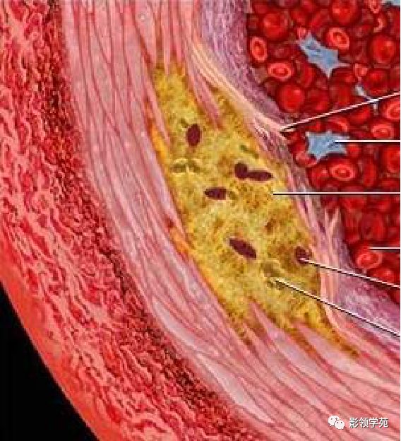 主动脉夹层壁间血肿如何鉴别,主动脉夹层血肿溃疡